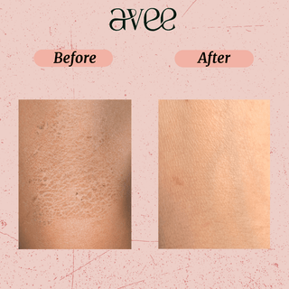 Before and after results with Avee Kids Body Wash, nourished soft skin with no irritation